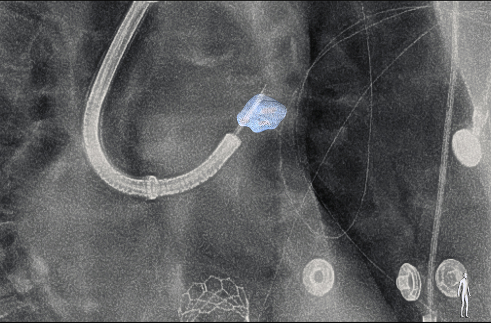 CBCT confirming the needle within the nodule 